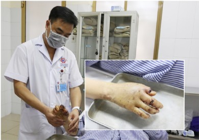 Giữ gần nguyên vẹn bàn tay cho bệnh nhân bị cối xay thịt nghiền nát