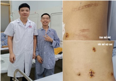 Phẫu thuật nội soi tạo hình lại khúc nối bể thận – niệu quản cho bệnh nhân bị tái hẹp sau mổ mở 5 năm