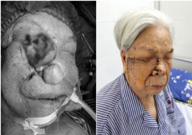 Phẫu thuật thành công khối ung thư lớn xâm lấn phức tạp vùng mặt cho cụ bà 96 tuổi