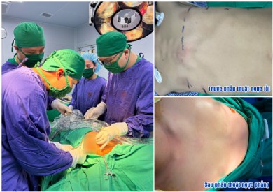 Làm chủ kỹ thuật Abramson, trả lại sự tự tin cho người bệnh lồi ngực bẩm sinh